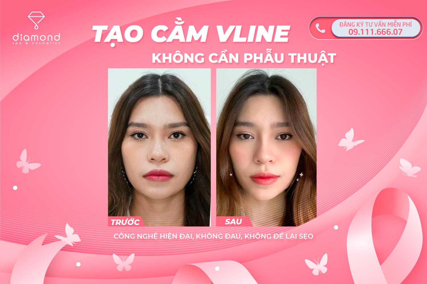 TẠO CẰM VLINE KHÔNG CẦN PHẪU THUẬT