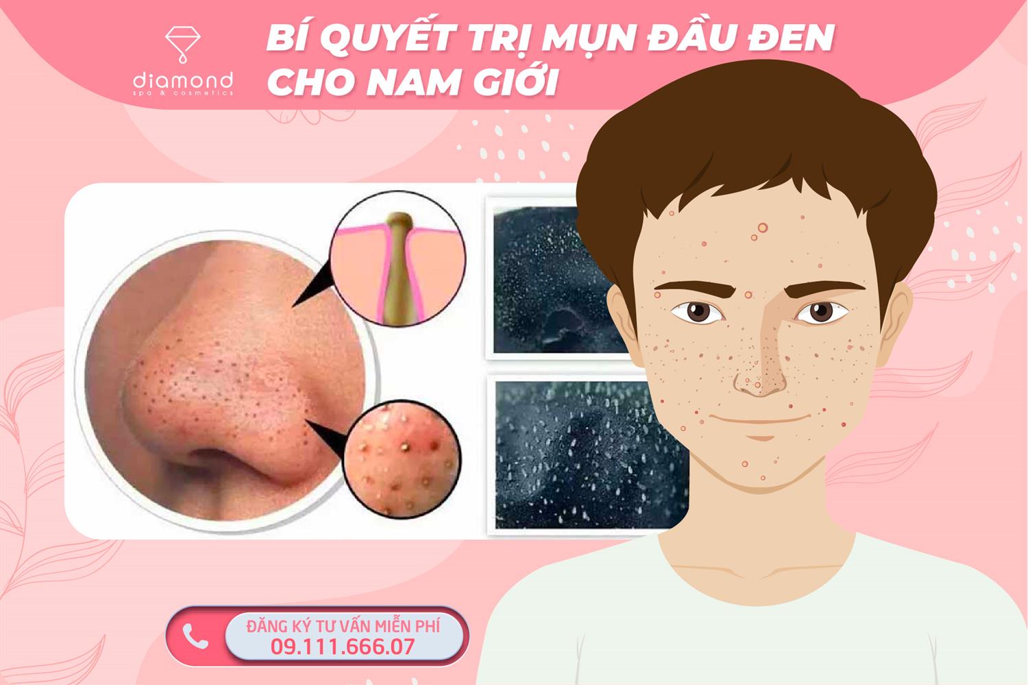 BÍ QUYẾT TRỊ MỤN ĐẦU ĐEN CHO NAM GIỚI