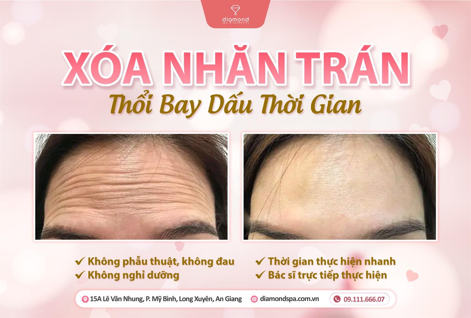 XÓA NHĂN TRÁN - THỔI BAY DẤU THỜI GIAN