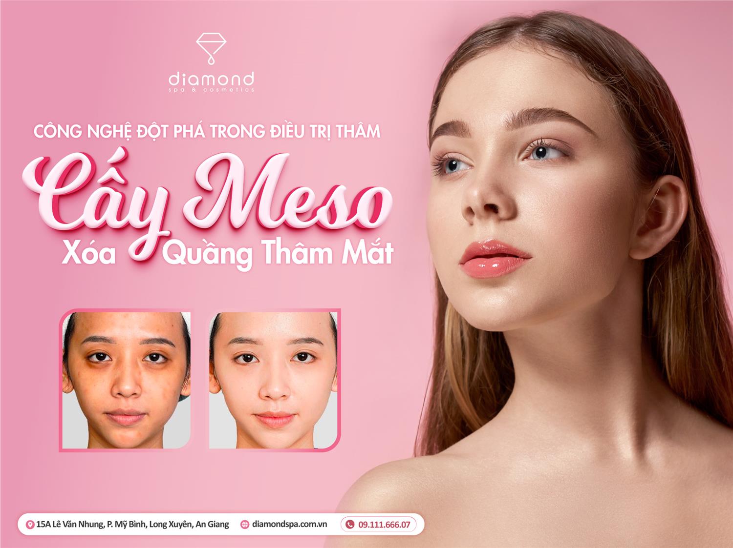 CẤY MESO XÓA QUẦNG THĂM MẮT