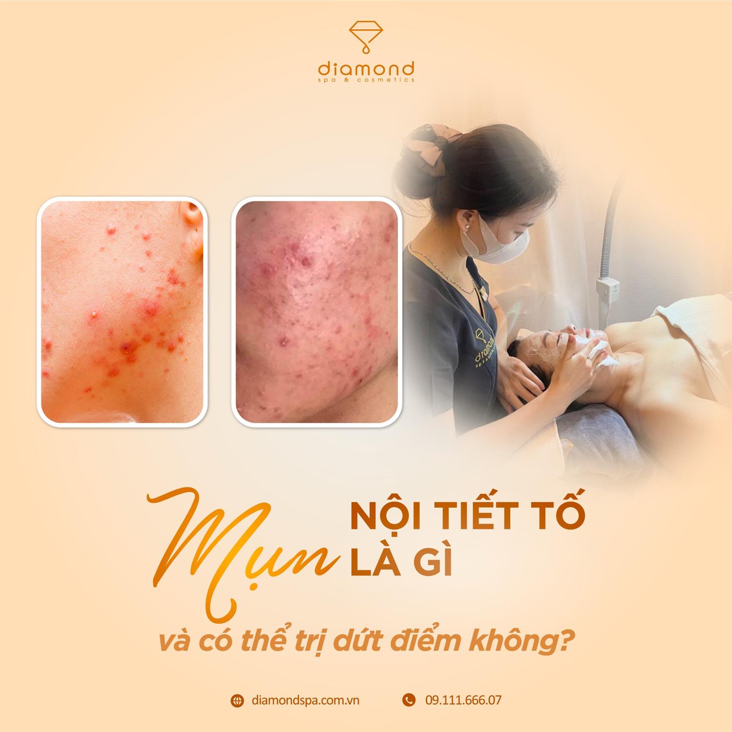 MỤN NỘI TIẾT TỐ LÀ GÌ VÀ CÓ THỂ TRỊ DỨT ĐIỂM KHÔNG?