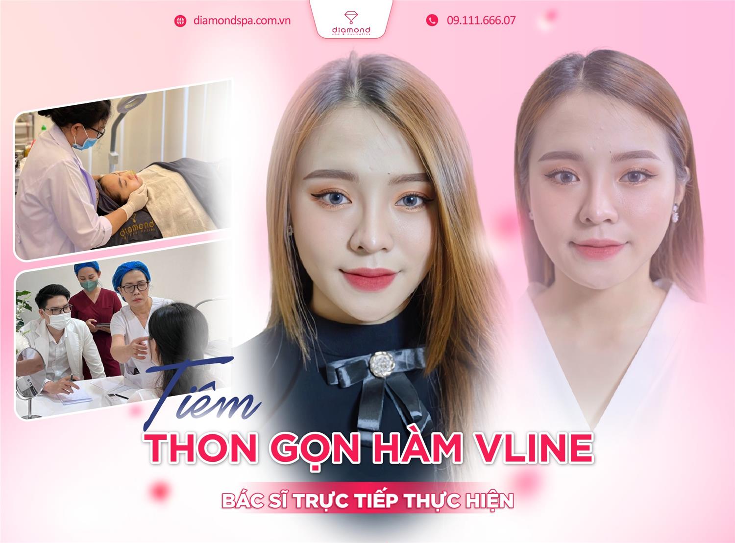 TIÊM THON GỌN HÀM VLINE