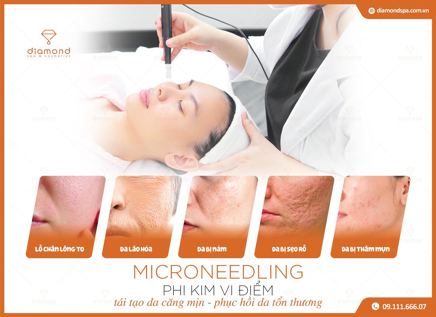 MICRONEEDLING - PHI KIM VI ĐIỂM