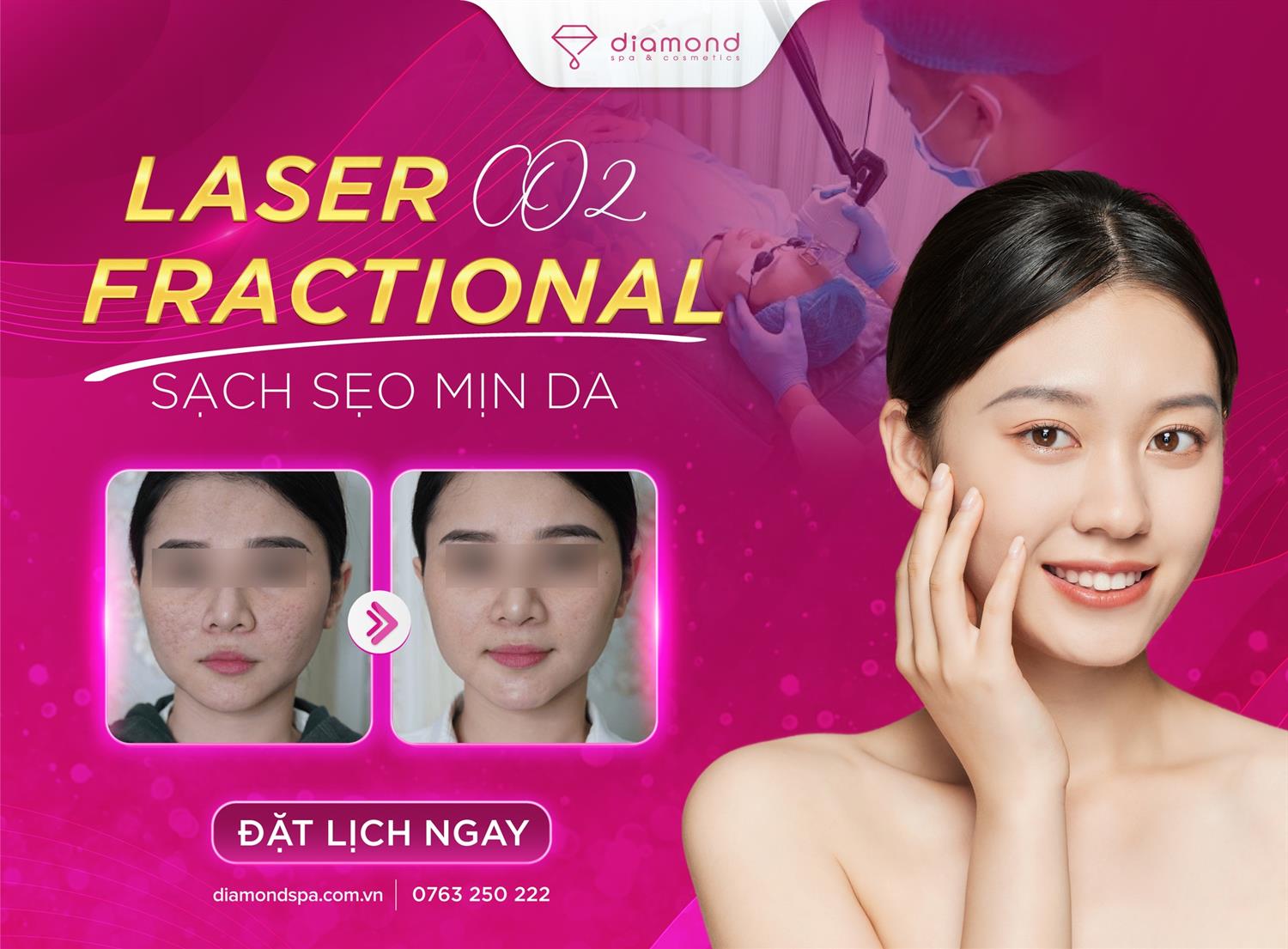 LASER CO2 FRACTIONAL - SẠCH XẸO MỊN DA