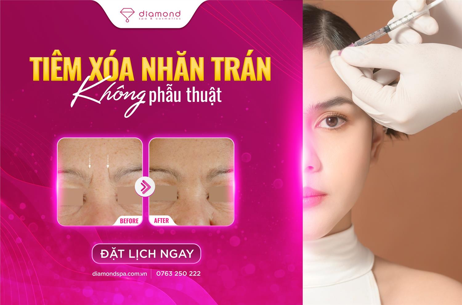 TIÊM XÓA NHĂN TRÁN KHÔNG PHẪU THUẬT