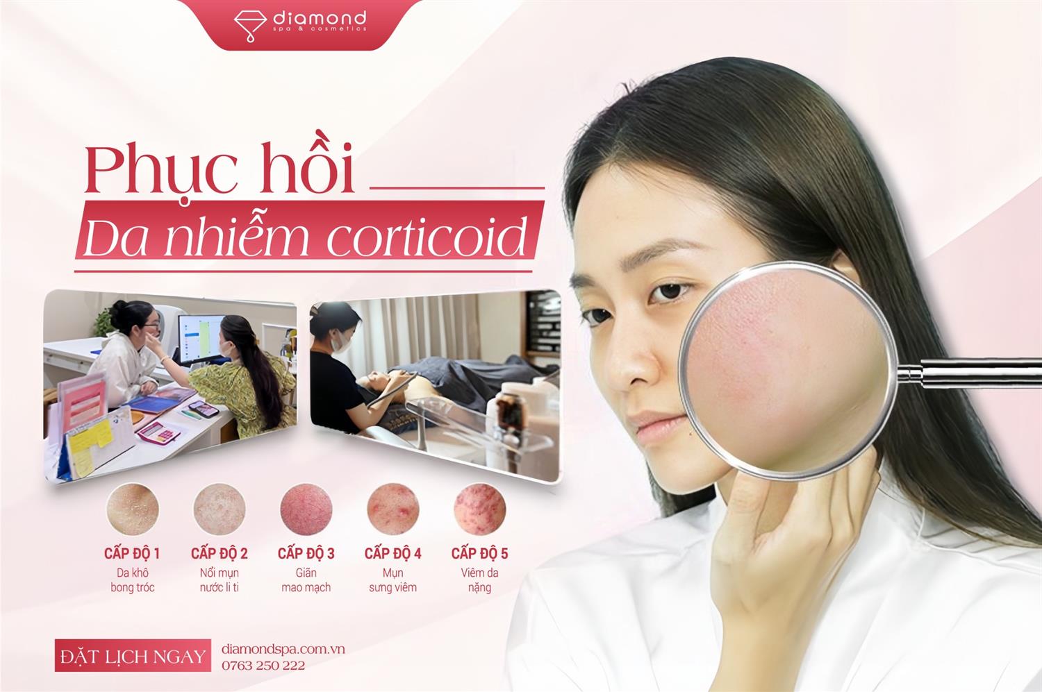 PHỤC HỒI DA NHIỄM CORTICOID