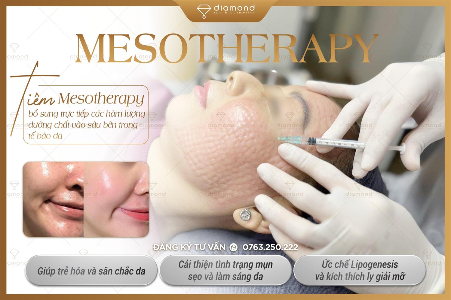 TIÊM MESOTHERAPY CĂNG BÓNG DA