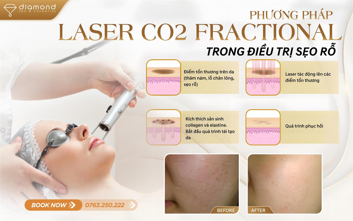 LASER CO2 FRACTIONAL - ĐIỀU TRỊ SẸO RỖ