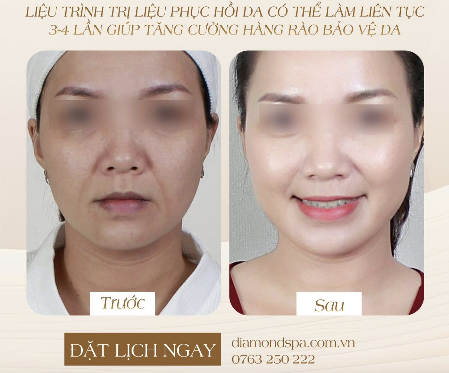 LIỆU TRÌNH HA COLLAGEN TẠI DIAMOND SPA