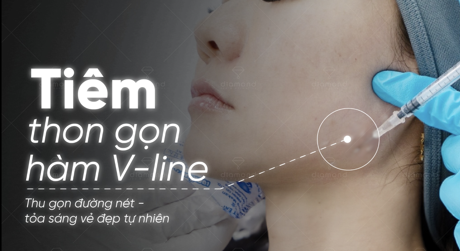 TIÊM THON GỌN HÀM VLINE