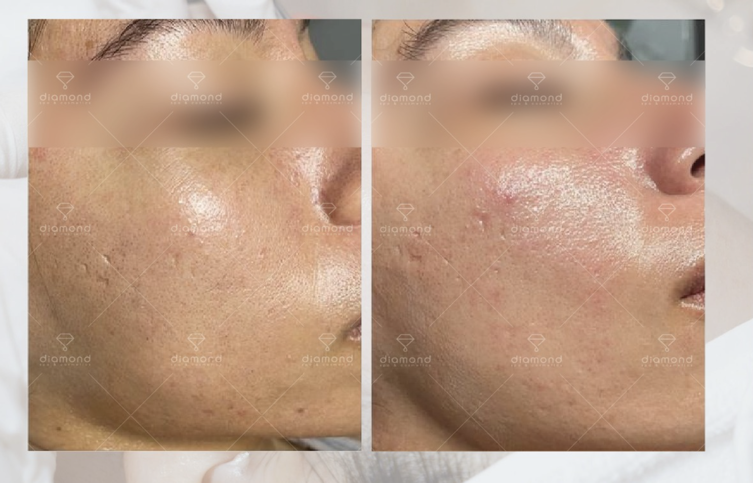 DERMAPLANING – BƯỚC ĐỆM HOÀN HẢO CHO LÀN DA HẤP THỤ DƯỠNG CHẤT TỐT HƠN