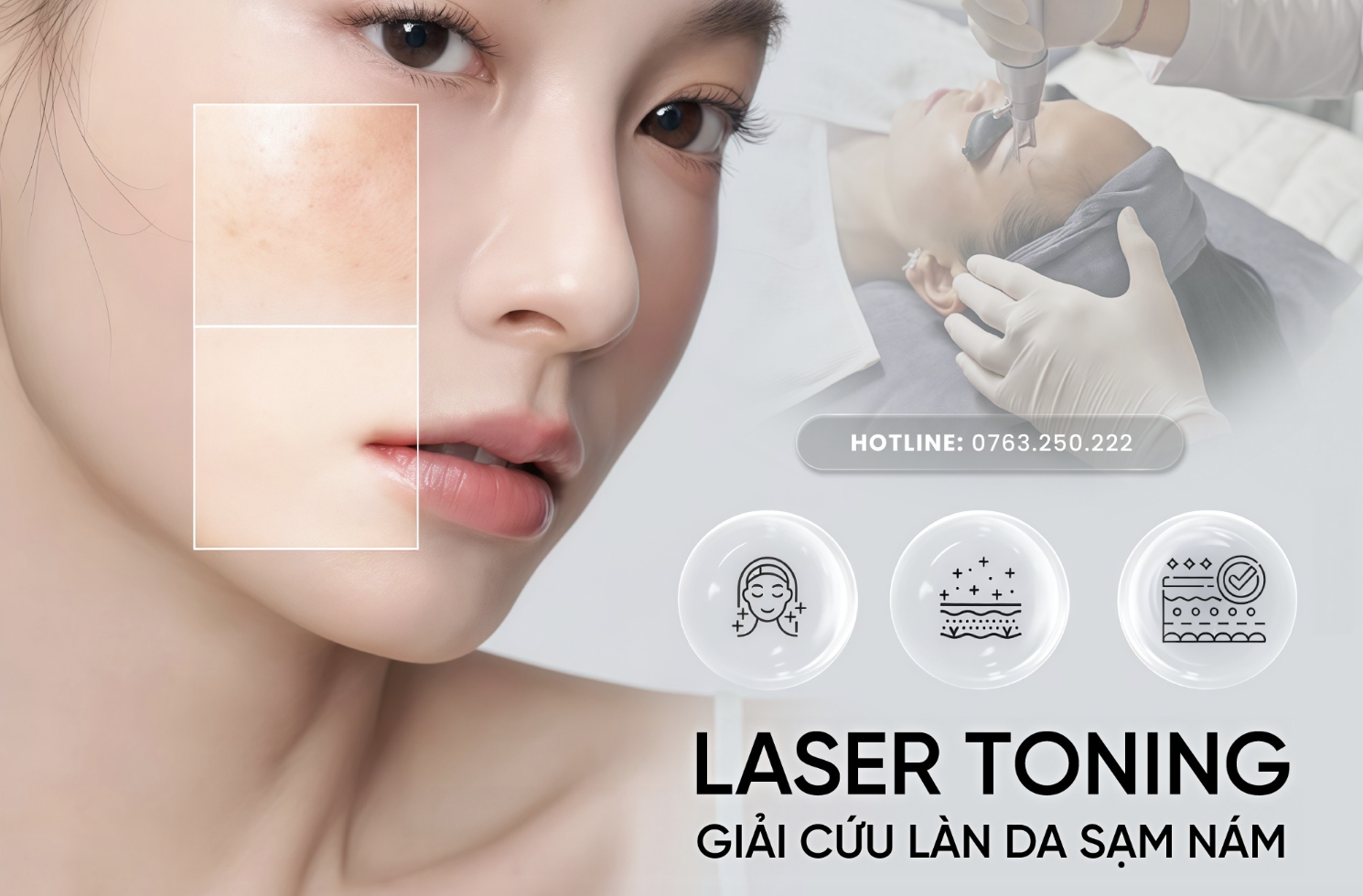 LASER TONING – GIẢI CỨU LÀN DA SẠM NÁM HIỆU QUẢ & AN TOÀN