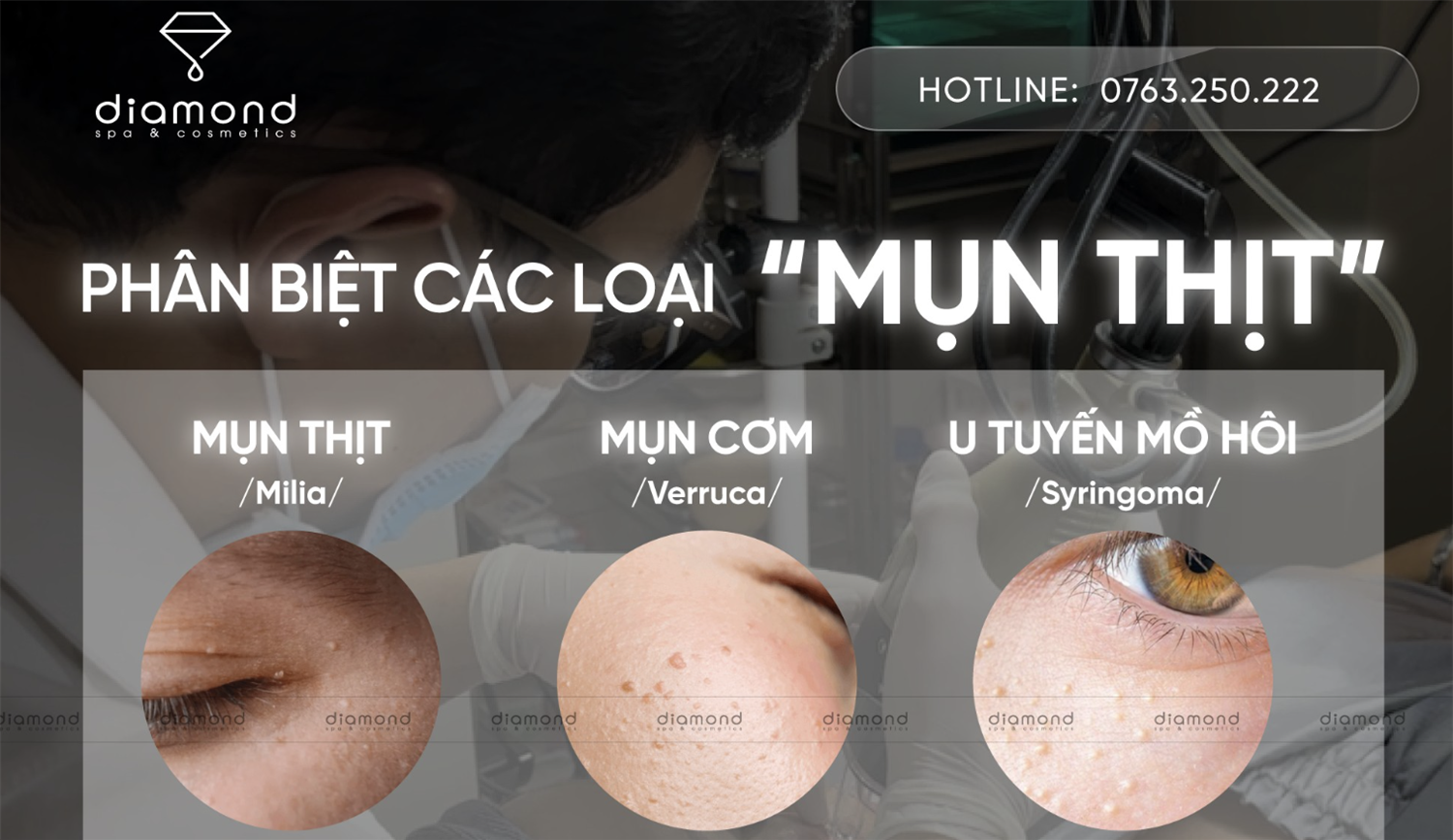  PHÂN BIỆT CÁC LOẠI “MỤN THỊT”