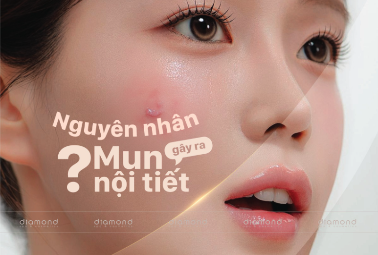 NGUYÊN NHÂN GÂY RA MỤN NỘI TIẾT