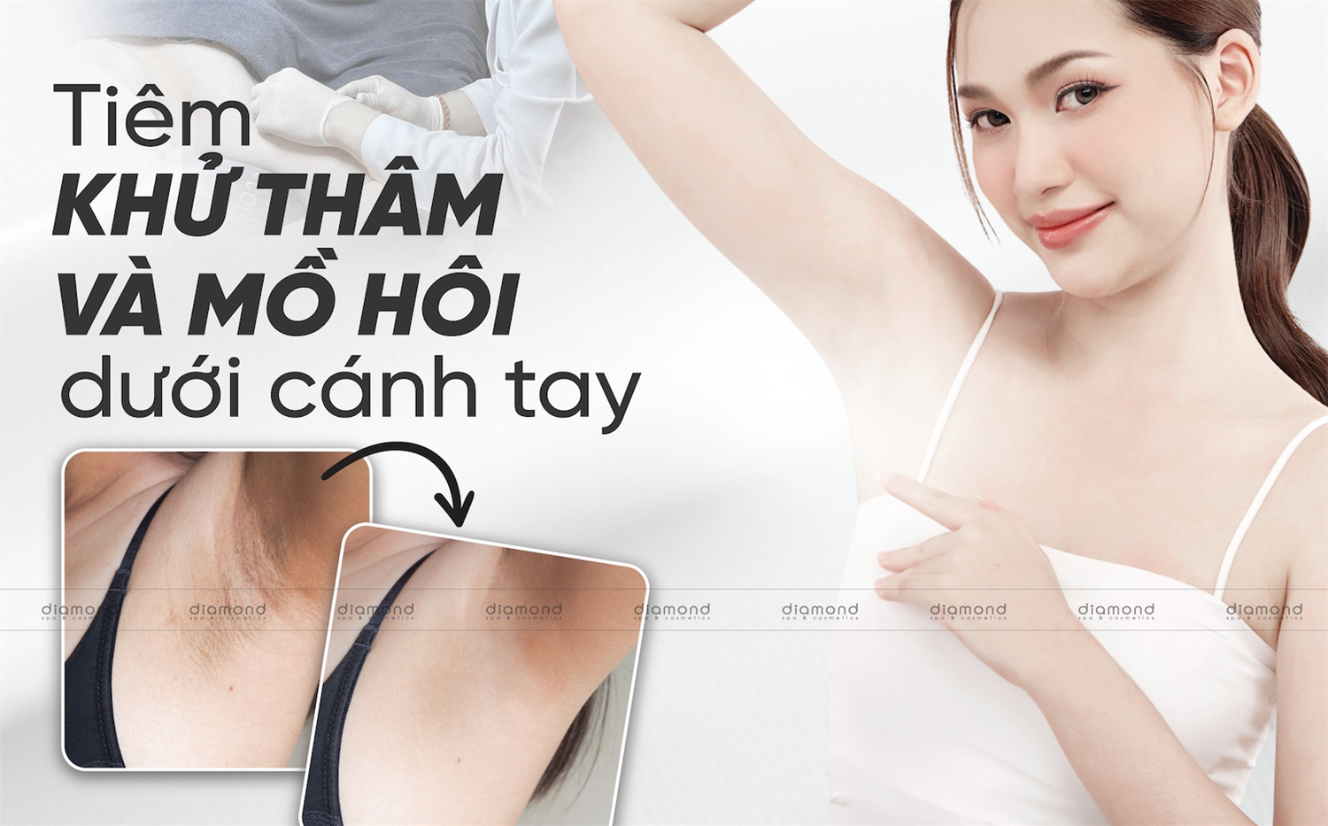 TIÊM KHỬ MỒ HÔI DƯỚI CÁNH TAY