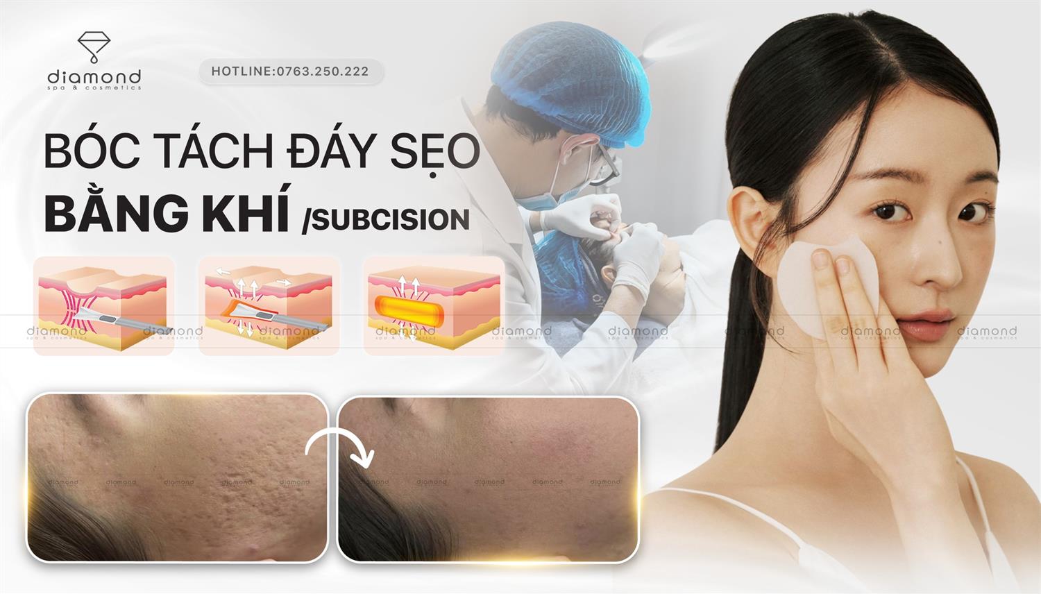BÓC TÁCH ĐÁY SẸO BẰNG KHÍ