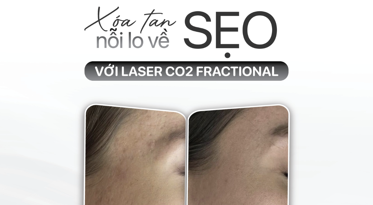  XÓA TAN NỖI LO VỀ SẸO – TÁI SINH LÀN DA MỊN MÀNG CÙNG LASER CO2 FRACTIONAL