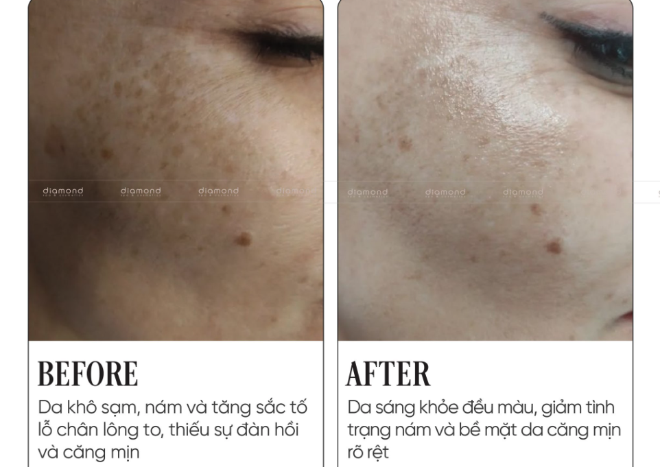LASER TONING – “BẬT SÁNG” LÀN DA, MỜ THÂM NÁM NHẸ NHÀNG 