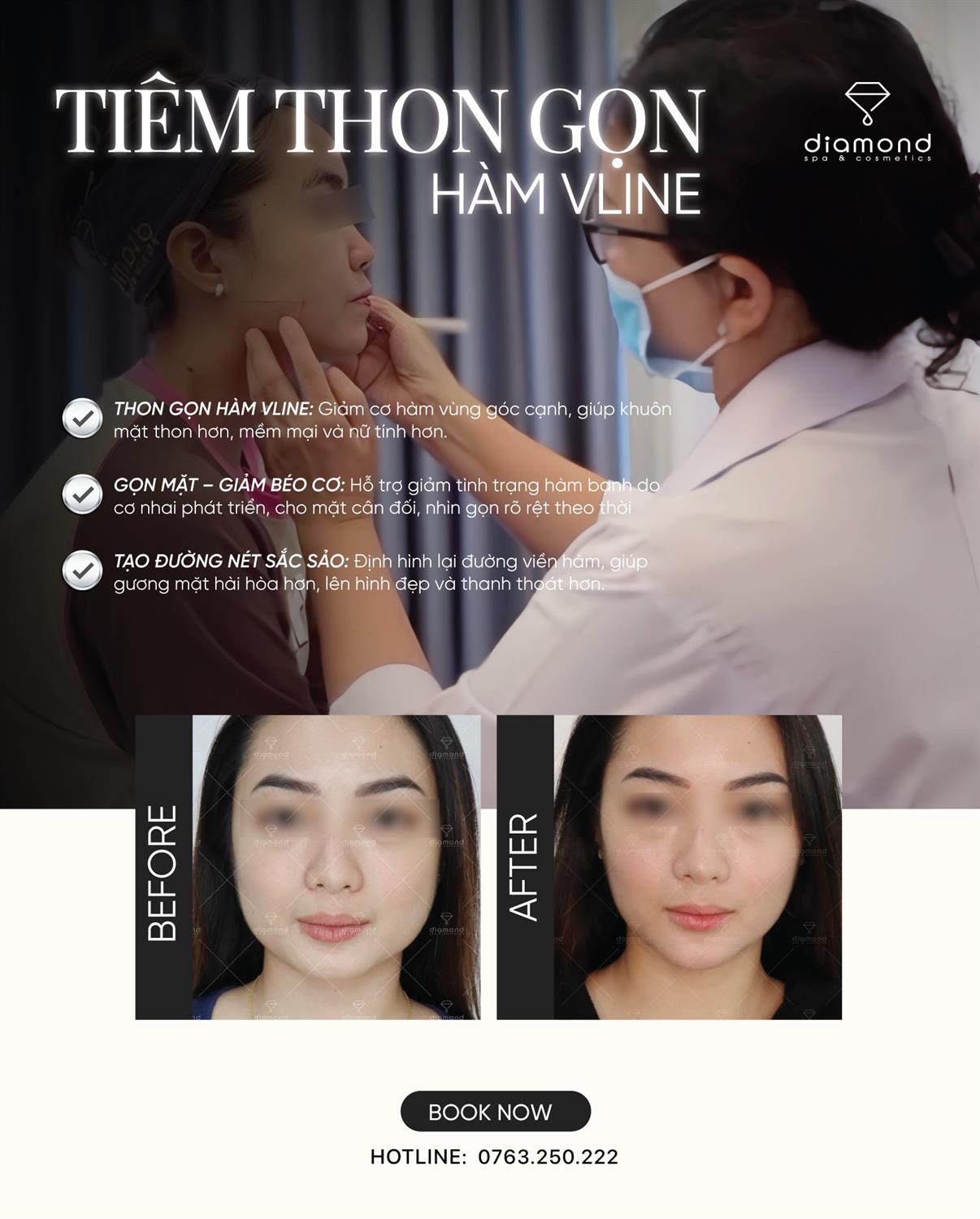 TIÊM THON GỌN HÀM – NHẸ NHÀNG CHO GƯƠNG MẶT VLINE TỰ NHIÊN