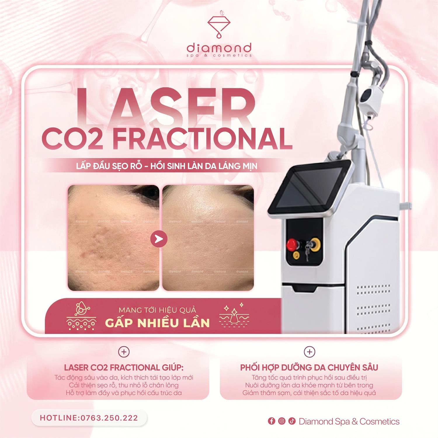 ĐÁNH THỨC LÀN DA KHÔNG TÌ VẾT VỚI LASER CO2 FRACTIONAL