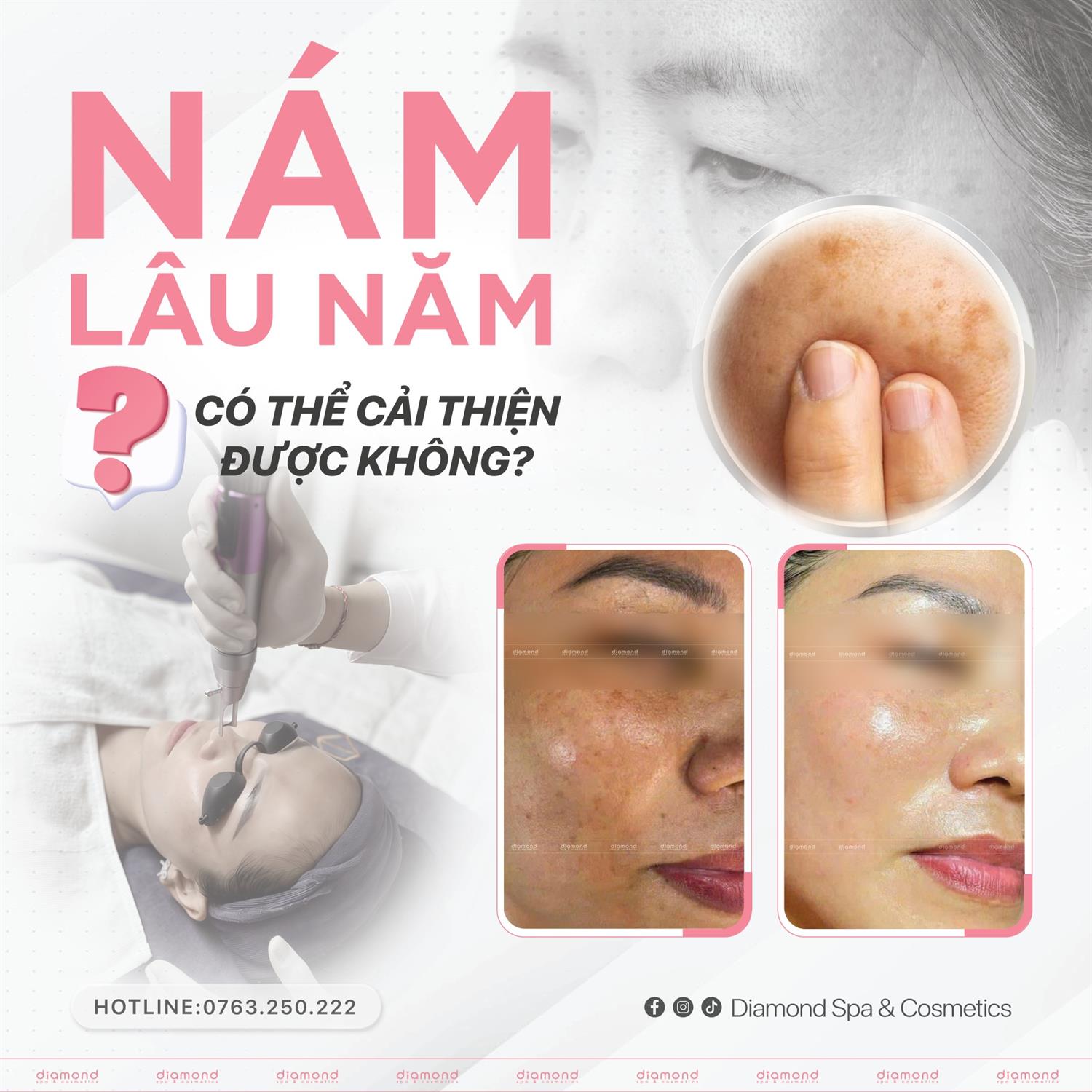 NÁM LÂU NĂM – CÓ THỂ CẢI THIỆN ĐƯỢC KHÔNG?