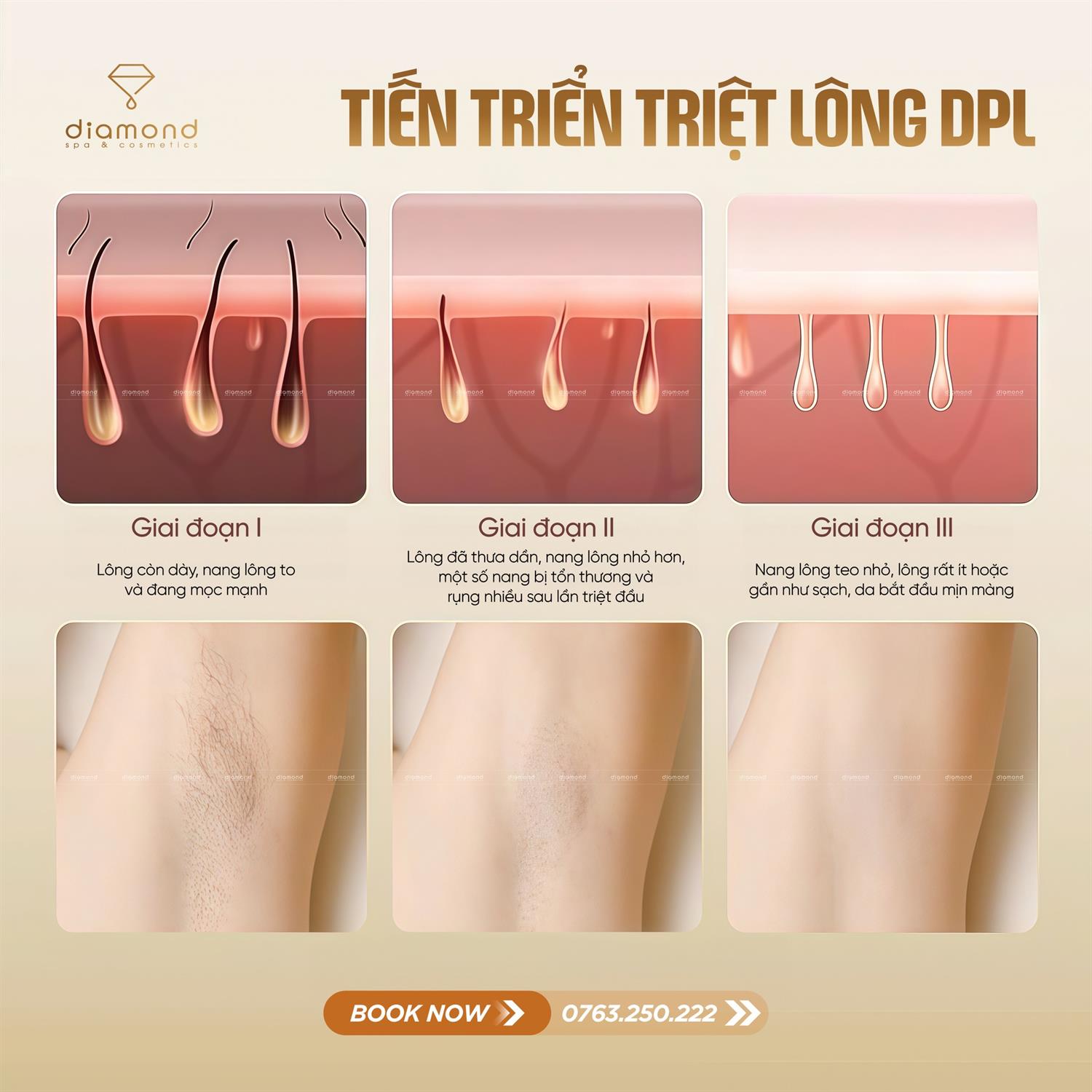 TRIỆT LÔNG CÔNG NGHỆ DPL 