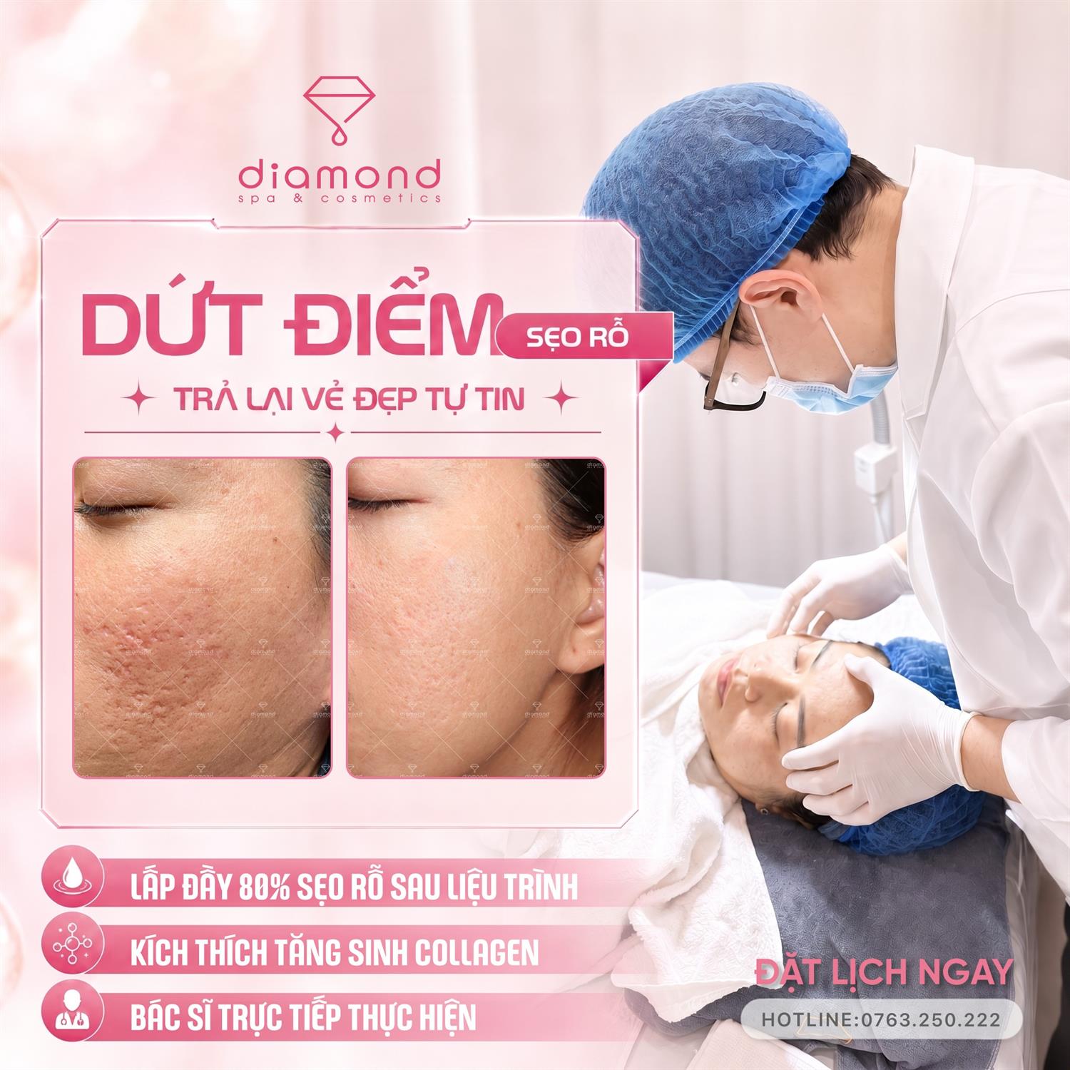 ĐIỀU TRỊ SẸO RỖ TẠI DIAMOND SPA