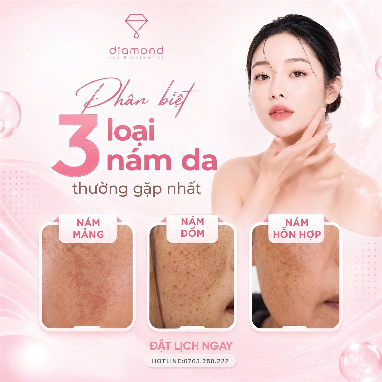 PHÂN BIỆT 3 LOẠI NÁM DA THƯỜNG GẶP