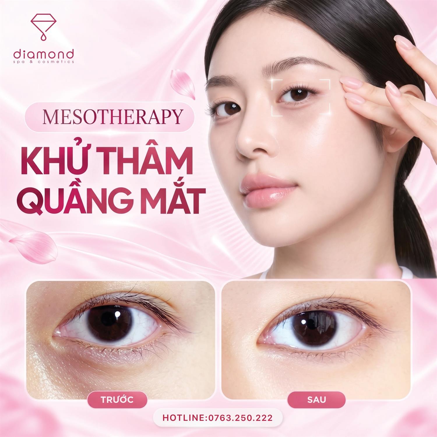 MESOTHERAPY KHỬ THÂM QUẦNG MẮT