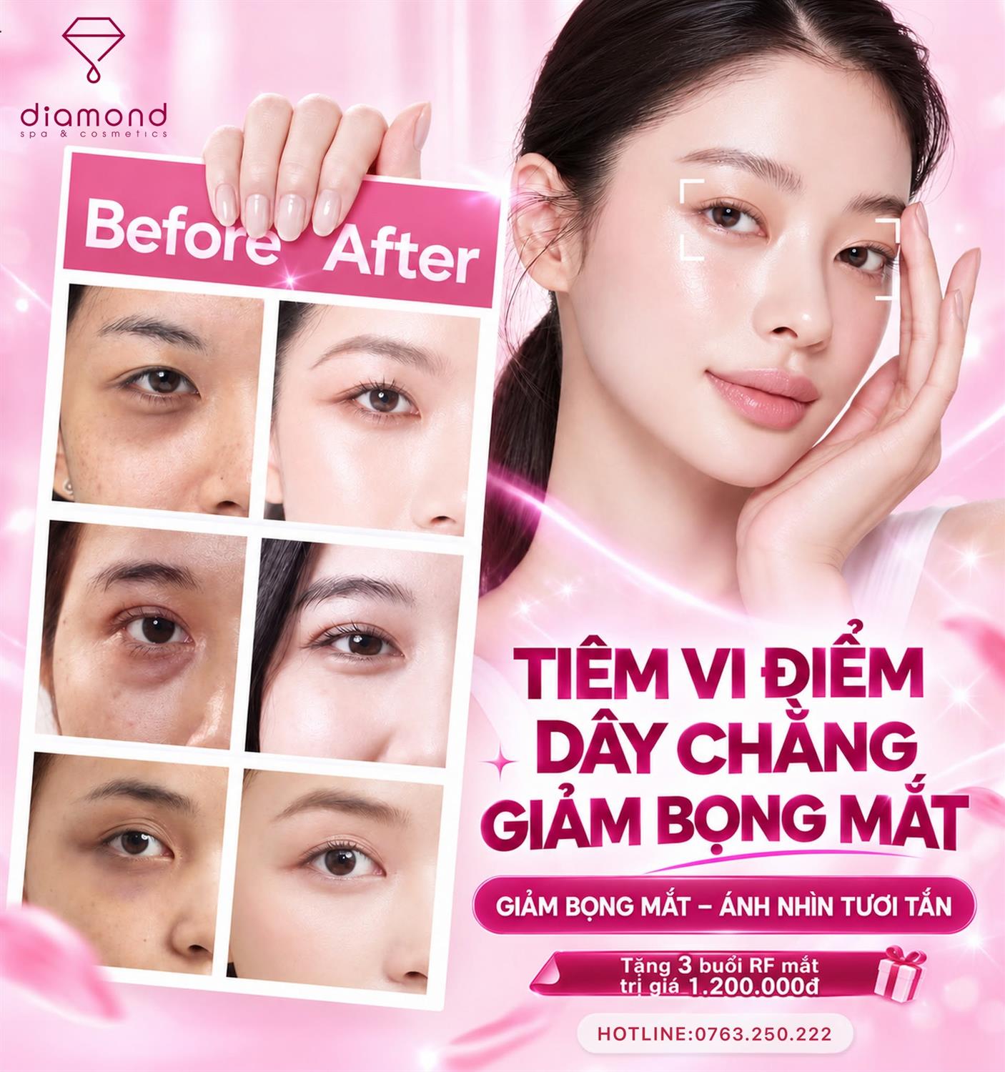 TIÊM VI ĐIỂM DÂY CHẰNG GIẢM BỌNG MẮT